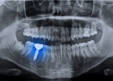 Benefits of Dental Implants Over Other Tooth Replacement Options