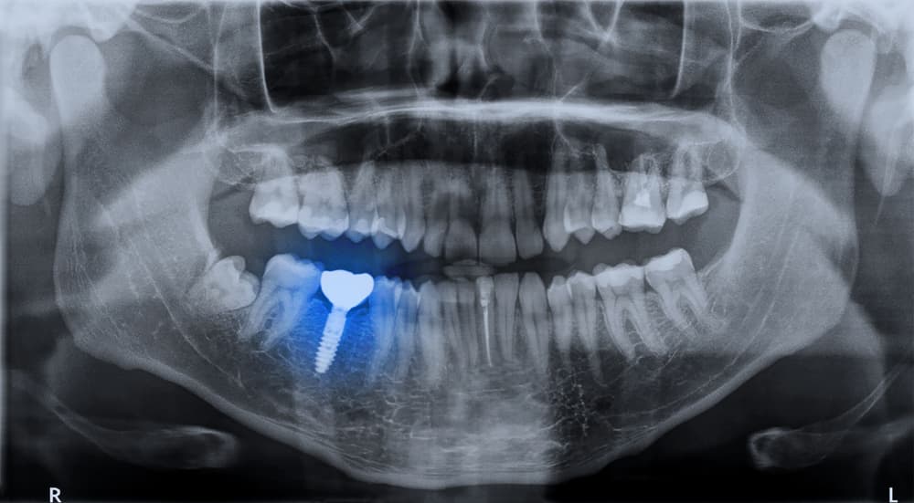 Benefits of Dental Implants