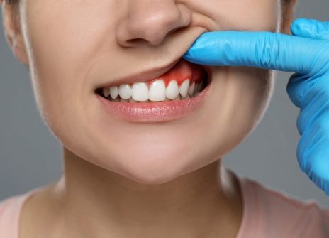 How to Avoid Gum Disease as You Age