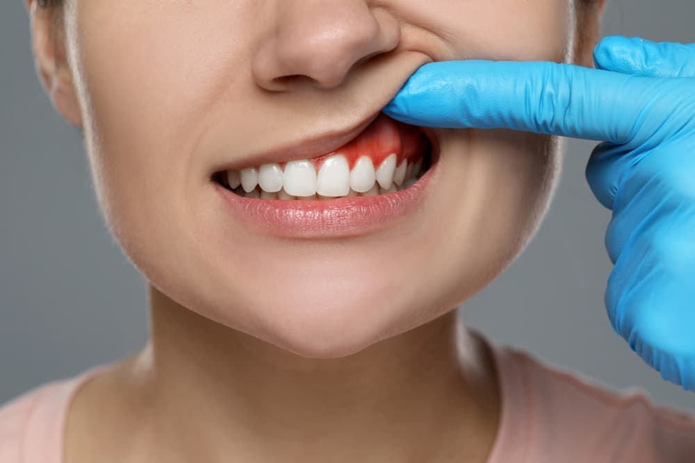 Gum Disease
