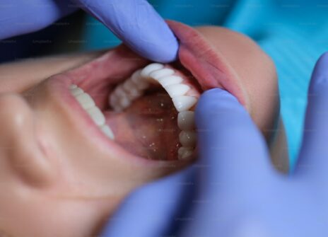 Teeth Whitening for Sensitive Teeth: A Dentist-Led Approach