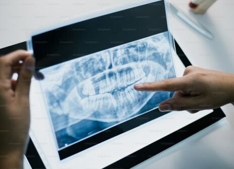 Teeth Grinding Treatment in Fulham: Causes, Symptoms & How to Stop Bruxism