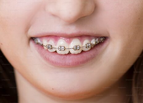 Invisalign vs Braces: Cost, Time & Results Compared
